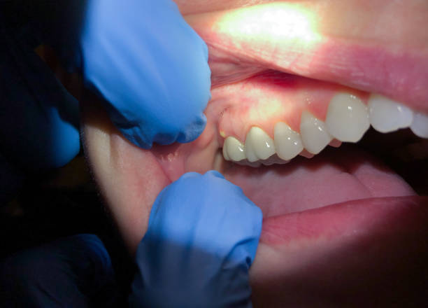 Best Emergency Treatment for Toothache in Choteau, MT